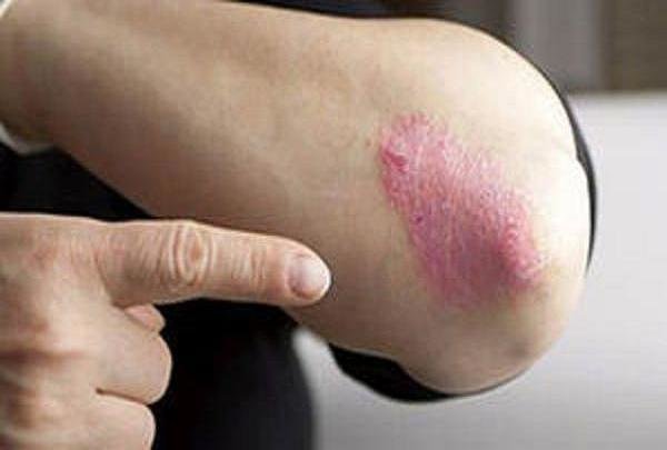 درمان اگزما موجب تسکین بیماری آسم می شود