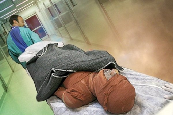 شیوع بالای سوختگی های حرارتی در ایران