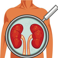 نشانه‌های عفونت کلیه را بشناسید