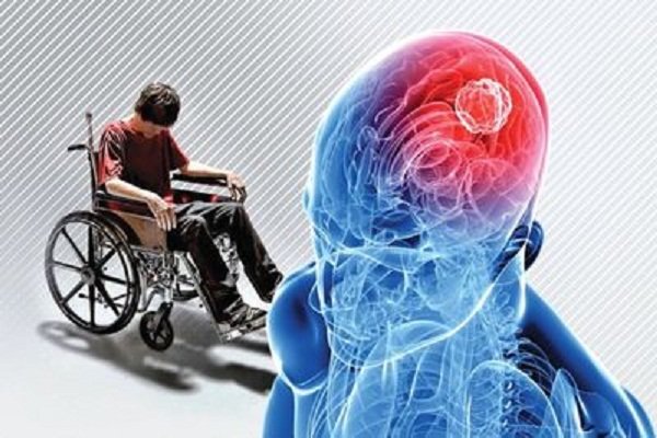 شناسایی پروتئینی که به درمان ام اس کمک می کند