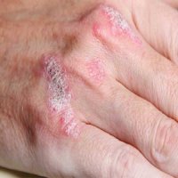 پسوریازیس خطر ابتلا به دیابت نوع 2 را افزایش می‌دهد