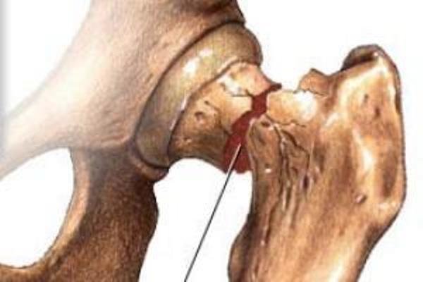 راه های پیشگیری از پوکی استخوان را بشناسید