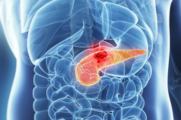 علائم ریفلاکس معده را جدی بگیرید/سه علامت خطرناک