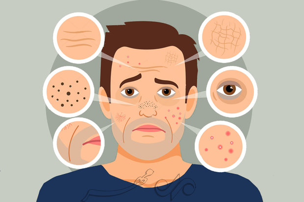 صابون های اسیدی راهی برای درمان پوست آکنه ای