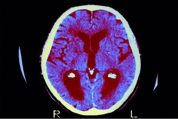 مقابله با آلزایمر با داروی درمان دیابت